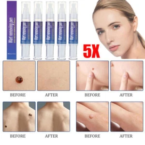 5Pack 12 Hours Wart Remover Pen Skin Tag Mole Foot Corn Eliminate Warts Unisex - Picture 1 of 16