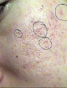 Perfect Complexion Cross Method Kit Pockennarben Reduktion - Bild 1 von 4