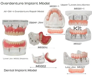 Dental Implant All on 4 Overdenture Model Upper/Lower Jaw with 2/4 Screw, Clear - Picture 1 of 67