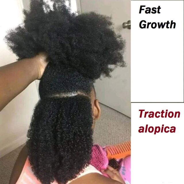 Traction Alopecia Hair Loss: How To Prevent and Treat