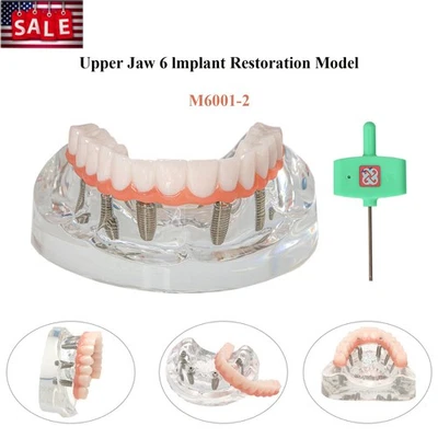 Модель зубного имплантата США All-On-6 демонстрационное лечение верхней челюсти 6 винтов прозрачные M6001-2 - Изображение 1 из 4