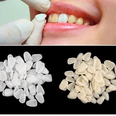 Juego de carillas de porcelana blanqueadoras personalizadas de dientes de belleza 50* carilla de resina dental A1/A2 Foto 1 de 4