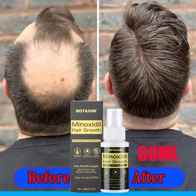Solución en aerosol tratamiento regeneración capilar Minoxidil 5% extra fuerza para hombres 60 ml Foto 1 de 4