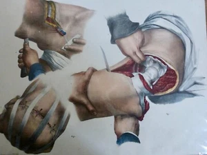1850 ANATOMIE CHIRURGIE Amputation de la jambe luxation hanche 1 LITHOGRAPHIE - Imagen 1 de 3