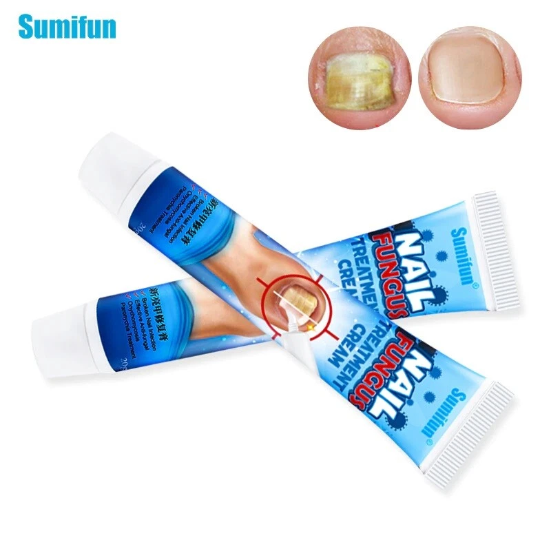 New Anti-Fungal Cream Foot Antifungal Nail Ointment Nail Care Sumifun 20g SALE