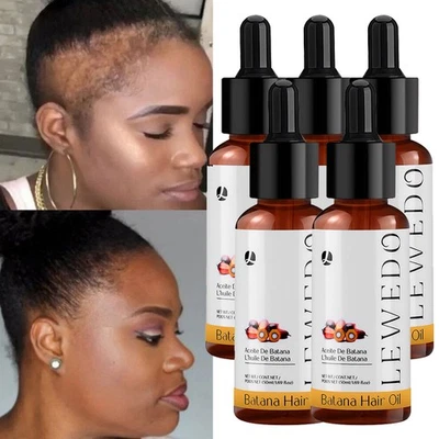 Suero de aceite de batana 5/3 unidades para el crecimiento del cabello más saludable más grueso más lleno anti pérdida de cabello Foto 1 de 4