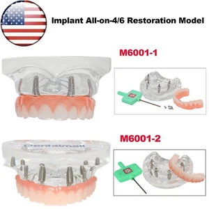 US Dental Overdenture Restoration Teeth Model Upper Jaw Type With 4/6 Screws - Picture 1 of 39