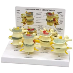 Lumbar Vertebrae Osteoporosis GPI Anat Set LFA #1760.Make Us an Offer! SEE VIDEO - Picture 1 of 3