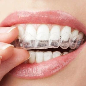 Corrector de dientes dental para adultos retenedor de dientes herramienta de enderezamiento - Imagen 1 de 11