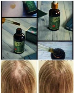 Bio Rehab Haarwachstum-Tonikum-Aktivator 100% Effektiv und Natural - Bild 1 von 5